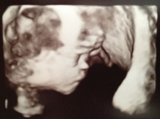 A 3d Facial Profile of Tucker @ 16 weeks